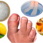 Ingrown Nails: Causes, Symptoms, Treatment and Home Remedies - Home