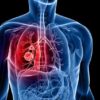 Watch out for Seven Early Symptoms of Lung Cancer