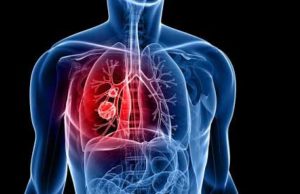 seven early symptoms of lung cancer