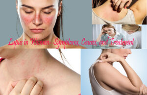 Lupus in Women- Symptoms, Causes, and Treatment