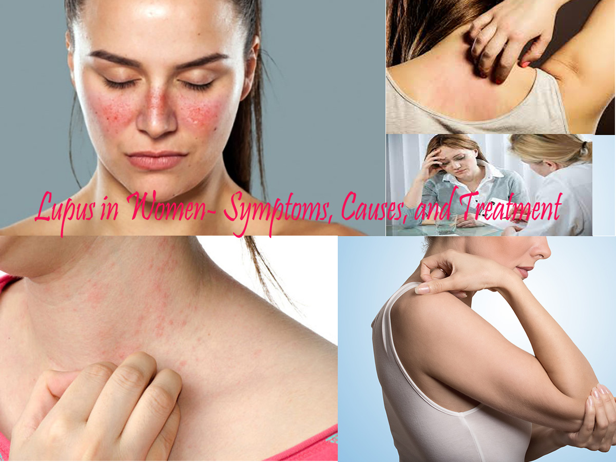 Lupus in Women- Symptoms, Causes, and Treatment