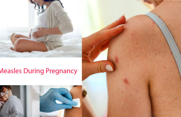 Measles During Pregnancy: How To Take Care Of yourself And Expecting Baby