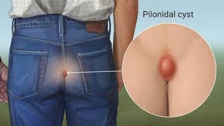 Home Remedies for Pilonidal Cyst