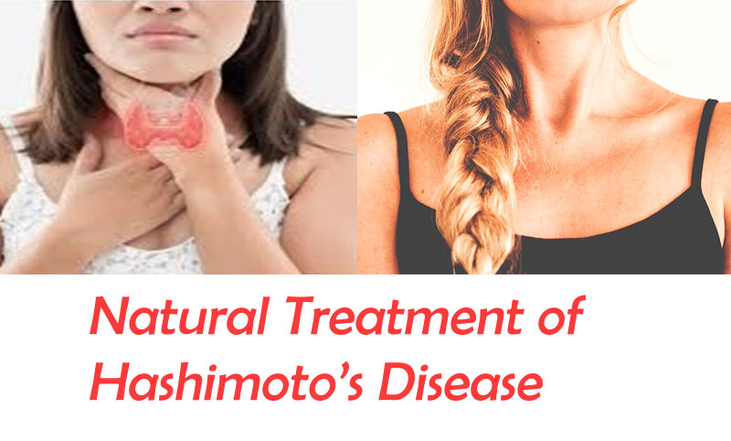 Natural Treatment of Hashimoto’s Disease