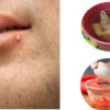 How To Get Rid Of Pimple On Lip Line