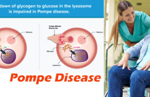 Pompe Disease: Causes, Symptoms, and Treatment