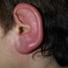 Red Hot Ear Pain: Symptoms, Causes, Manage and Home Remedies