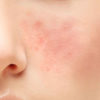 Rosacea -Symptoms, Causes, Treatment And Home Remedies