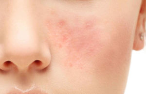 Rosacea -Symptoms, Causes, Treatment And Home Remedies
