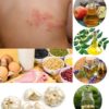 Shingles or Herpes Zoster: Causes, Symptoms and Home Remedies