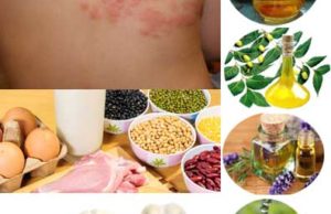 Shingles or Herpes Zoster and Home Remedies