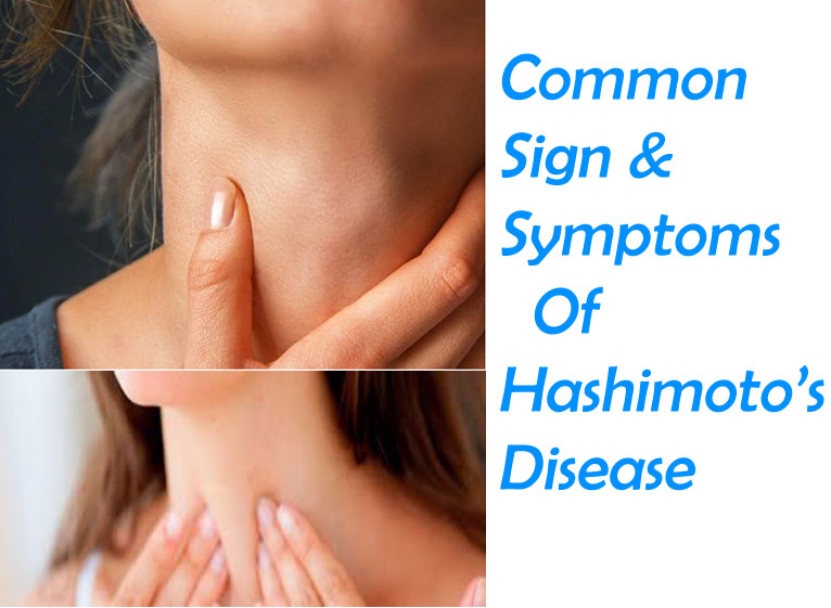 Common  Sign & Symptoms Of Hashimoto’s Disease