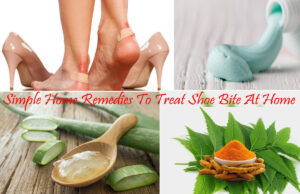 Simple Home Remedies To Treat Shoe Bite At Home