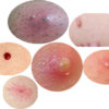 Skin Conditions Below Your Waist: Cysts, Boils, & Skin Tags