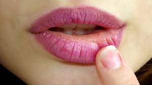 Smoking Harmful Effects on Women's Skin - Black Lips, Fine Lines & Wrinkles Around The Mouth