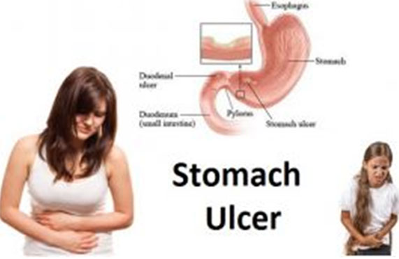What Are The Causes Of Stomach Ulcers?