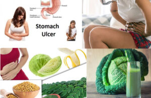 Stomach Ulcers (Gastric Ulcer): Causes, Symptoms, Natural Remedies And Prevention