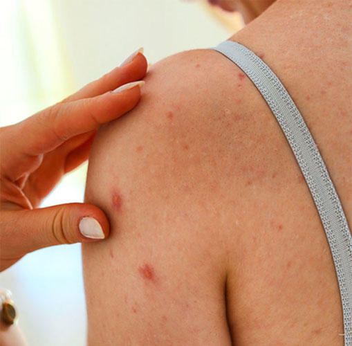 The Typical Symptoms And Signs Of Measles Infection