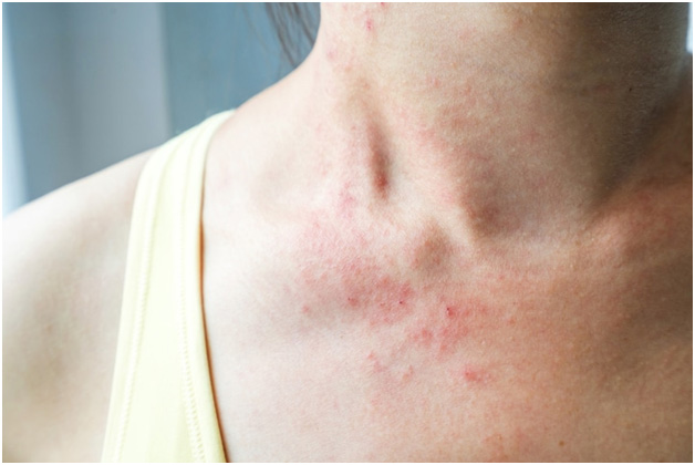 What are the Symptoms of Heat Rash