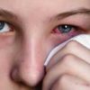 What is Viral Conjunctivitis During Monsoons:Causes, Symptoms, Treatment and Home Remedies
