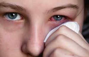 Cause of Viral Conjunctivitis