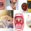 Tonsil Stones: Causes, Symptoms and Home Remedies