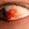 How to Treat Burst Blood Vessel in the Eye