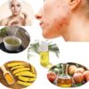 Treat Hormonal Acne in Females with Natural Home Remedies