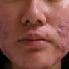 How to Treat Severe Acne