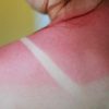 How to Treat Sunburns To Skin