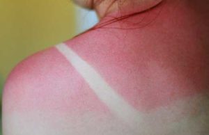 How to Treat Sunburns