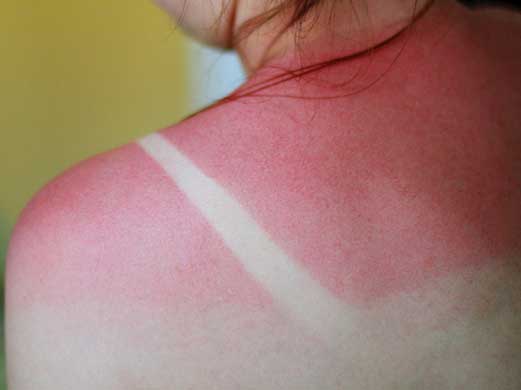 How to Treat Sunburns