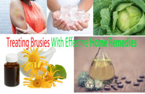 Treating Brusies With Effective Home Remedies