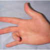 Trigger Finger: Symptoms And Home Remedies