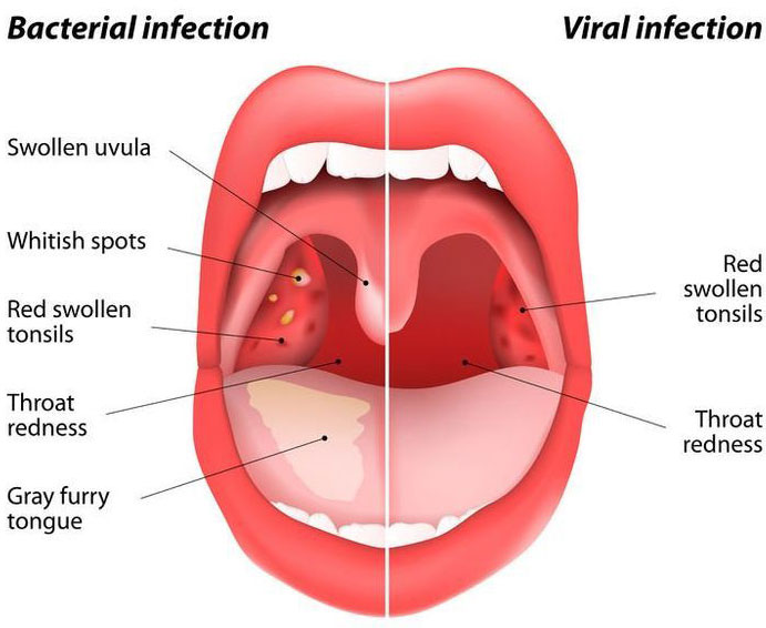 Causes of Uvulitis
