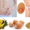 Vaginal Boil: Causes, Treatment and Home Remedies