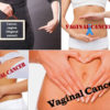 Vaginal Cancer: Symptoms, Causes and Treatment