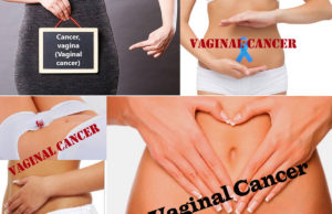 Vaginal Cancer: Symptoms, Causes and Treatment