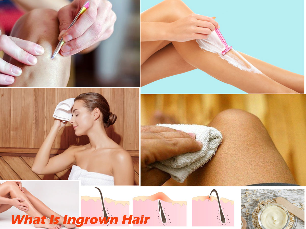 What Is Ingrown Hair: Symptoms, Causes, Ways To Avoid Ingrown Hair & Home Remedies