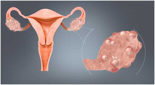 What Are The Root Causes Of PCOS